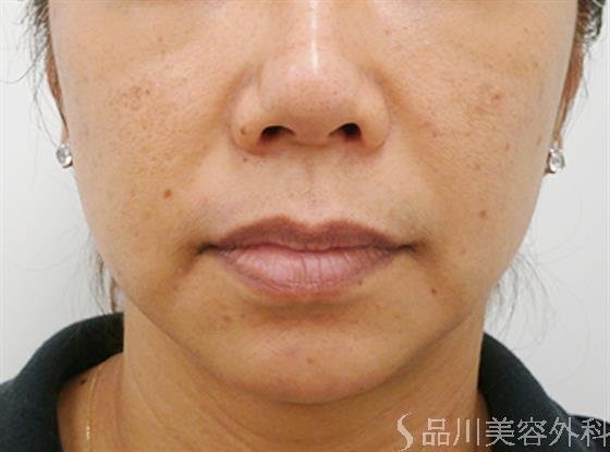 症例NO.30064のAFTER写真