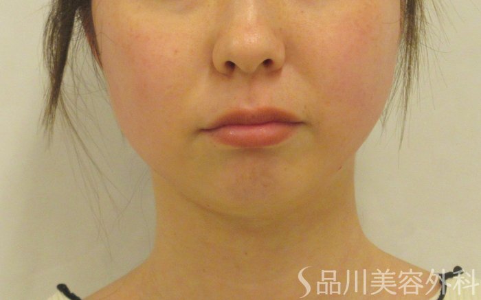 症例NO.72472のAFTER写真