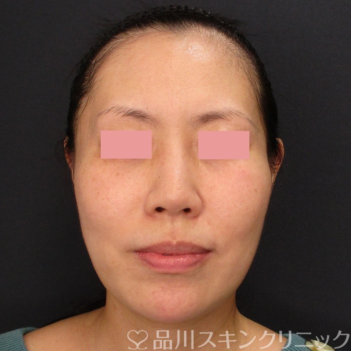 症例NO.71857のAFTER写真