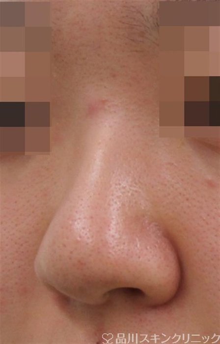 症例NO.38643のBEFORE写真
