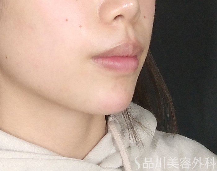 症例NO.69442のAFTER写真