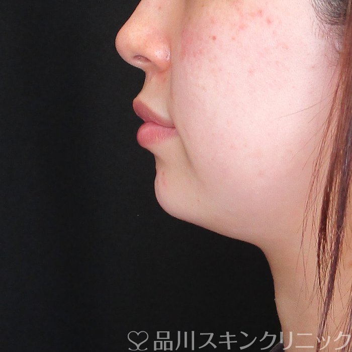 症例NO.74296のAFTER写真