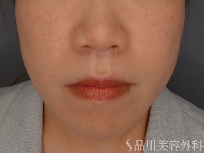 症例NO.73666のAFTER写真