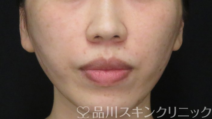 症例NO.70866のAFTER写真