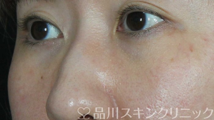 症例NO.71818のAFTER写真