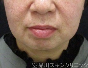 症例NO.69884のBEFORE写真