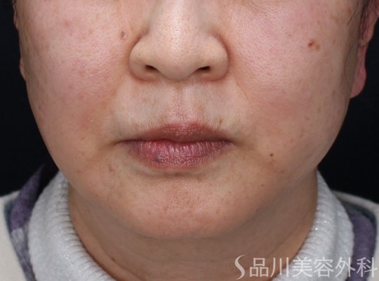 症例NO.73764のAFTER写真