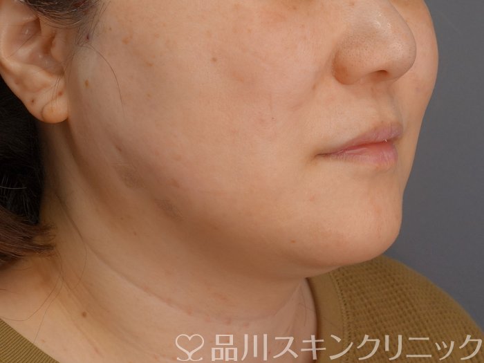 症例NO.72994のAFTER写真