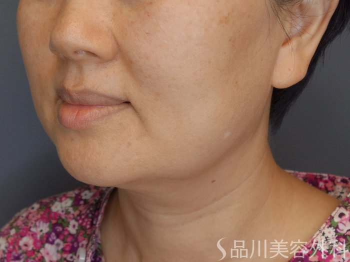 症例NO.71657のBEFORE写真