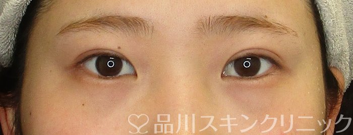 症例NO.74045のBEFORE写真
