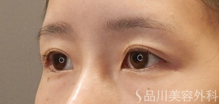 症例NO.68027のBEFORE写真