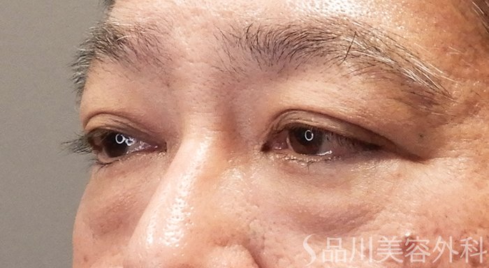 症例NO.69898のBEFORE写真