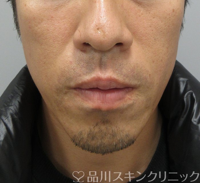 症例NO.74732のAFTER写真