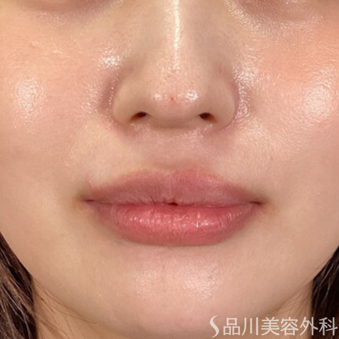 症例NO.65236のAFTER写真