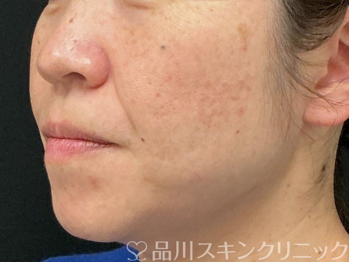 症例NO.74277のBEFORE写真