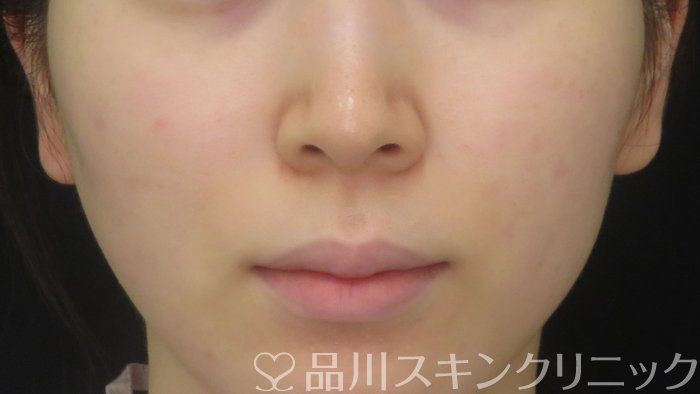 症例NO.70820のAFTER写真