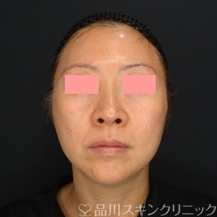 症例NO.71074のAFTER写真