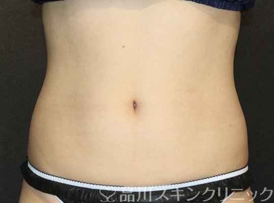 症例NO.73229のAFTER写真