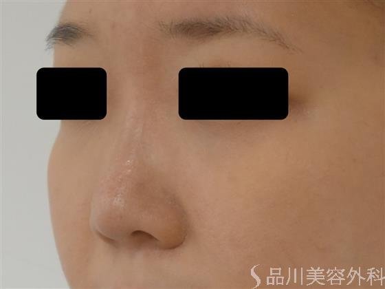 症例NO.38470のBEFORE写真
