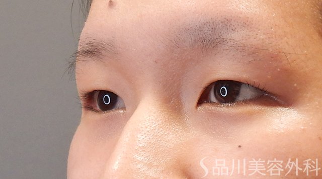 症例NO.75314のBEFORE写真