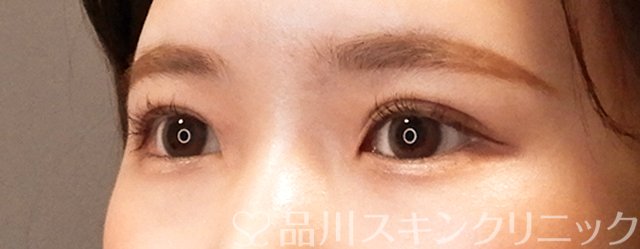 症例NO.70028のAFTER写真