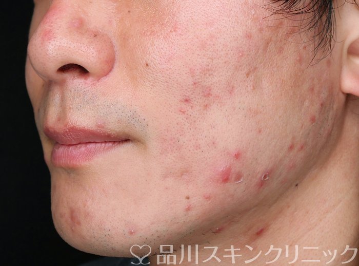 症例NO.72555のBEFORE写真