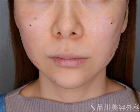 症例NO.51643のAFTER写真
