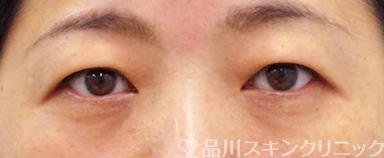 症例NO.50338のBEFORE写真
