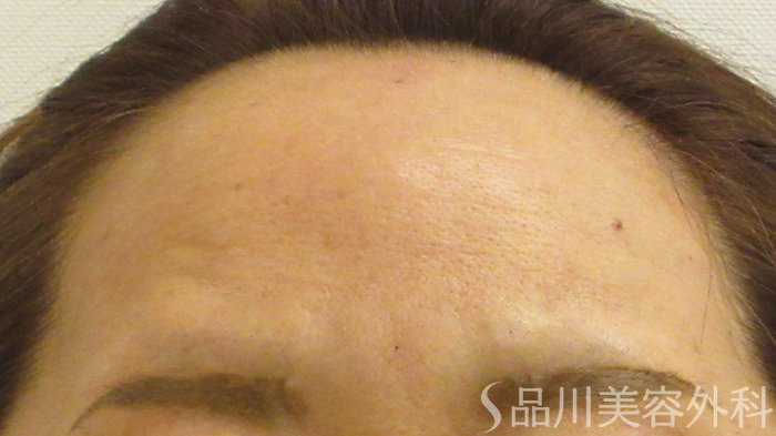 症例NO.71906のAFTER写真