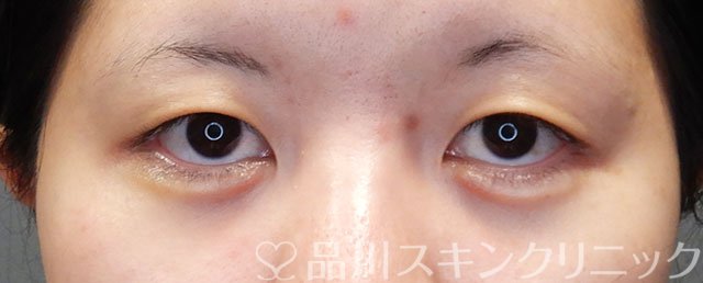 症例NO.74494のAFTER写真