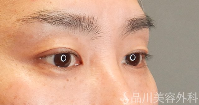 症例NO.75249のBEFORE写真