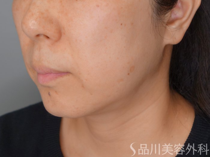 症例NO.70608のBEFORE写真