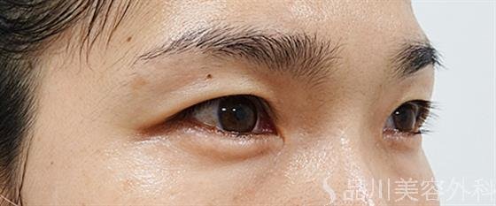 症例NO.53744のBEFORE写真