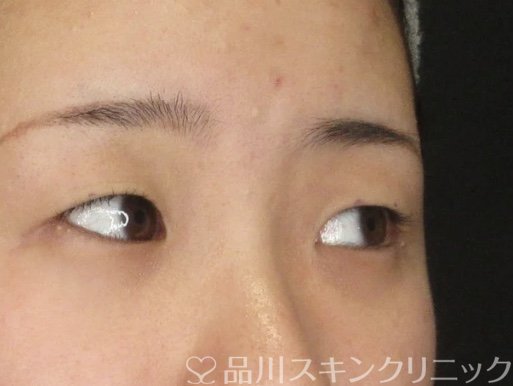 症例NO.69332のBEFORE写真