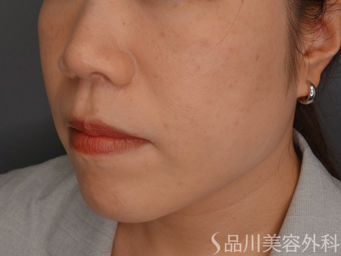 症例NO.73666のAFTER写真