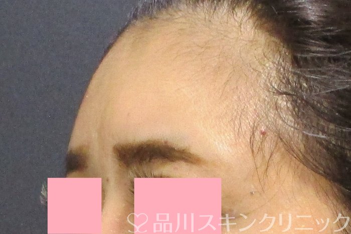 症例NO.74240のBEFORE写真