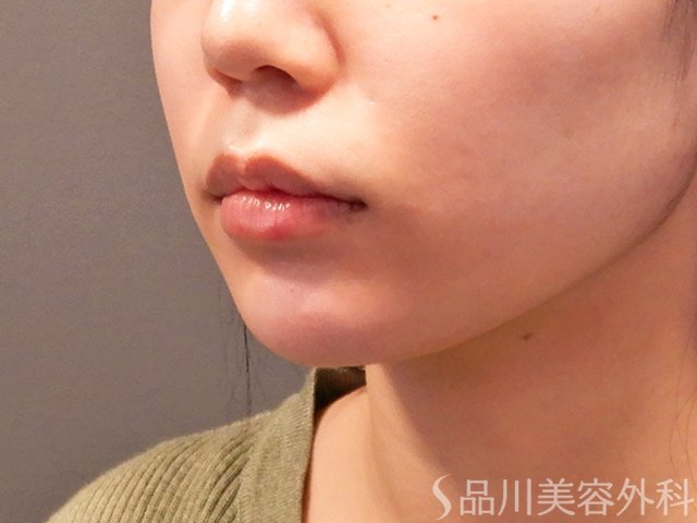 症例NO.69914のAFTER写真