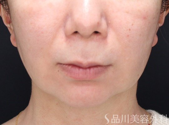 症例NO.69969のBEFORE写真