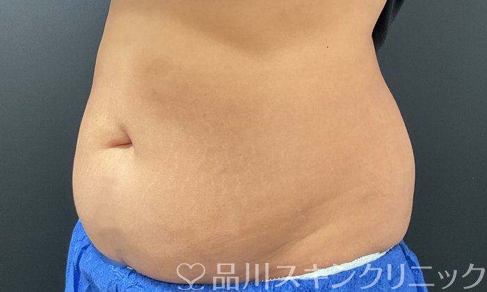 症例NO.74641のBEFORE写真