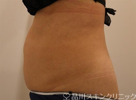 症例NO.44217のBEFORE写真