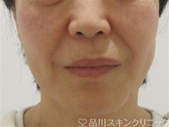 症例NO.38536のAFTER写真