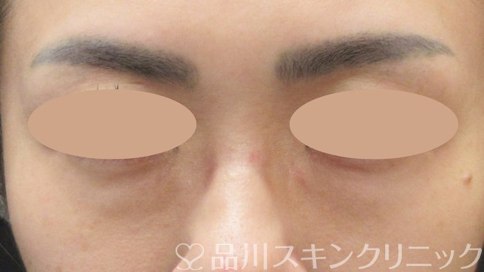 症例NO.73843のBEFORE写真