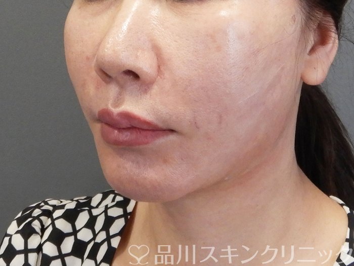 症例NO.75178のAFTER写真