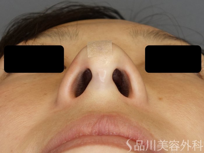 症例NO.72949のAFTER写真