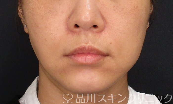 症例NO.72868のAFTER写真