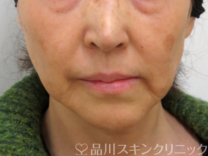 症例NO.73763のBEFORE写真