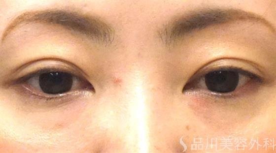 症例NO.27046のAFTER写真