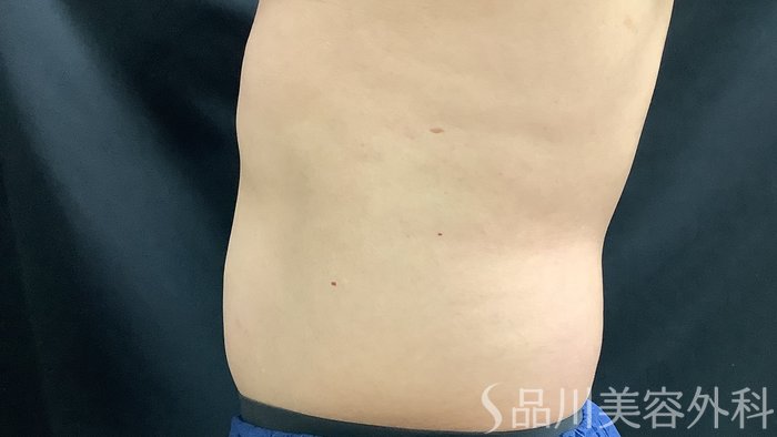 症例NO.75386のBEFORE写真