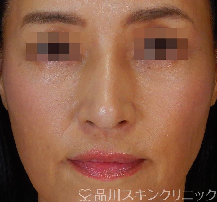 症例NO.66883のBEFORE写真