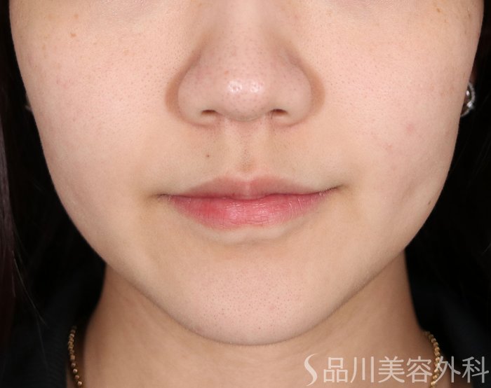 症例NO.70837のBEFORE写真